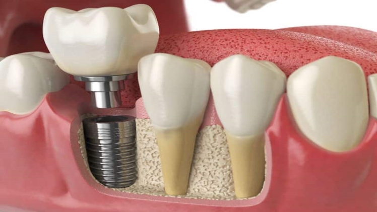 Content image for Dental Care After Tooth Loss: Navigating Bridges, Dentures, and Implants