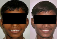 Featured image for The Challenge of Affordable Orthodontic Care: Straightening Teeth Without Breaking the Bank