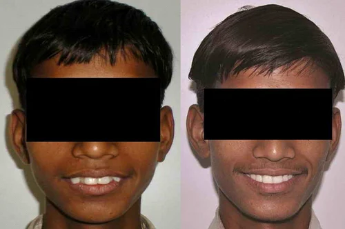 Featured image for The Challenge of Affordable Orthodontic Care: Straightening Teeth Without Breaking the Bank