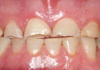 Featured image for Dental Care and Grinding Teeth (Bruxism): Protecting Your Smile at Night