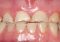 Featured image for Dental Care and Grinding Teeth (Bruxism): Protecting Your Smile at Night
