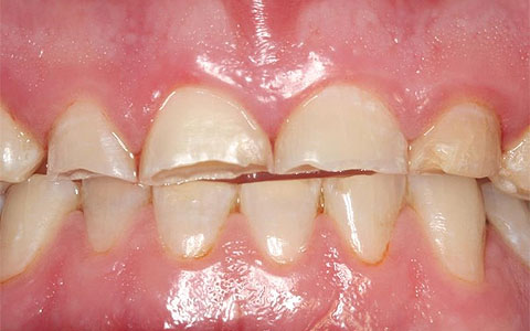 Featured image for Dental Care and Grinding Teeth (Bruxism): Protecting Your Smile at Night