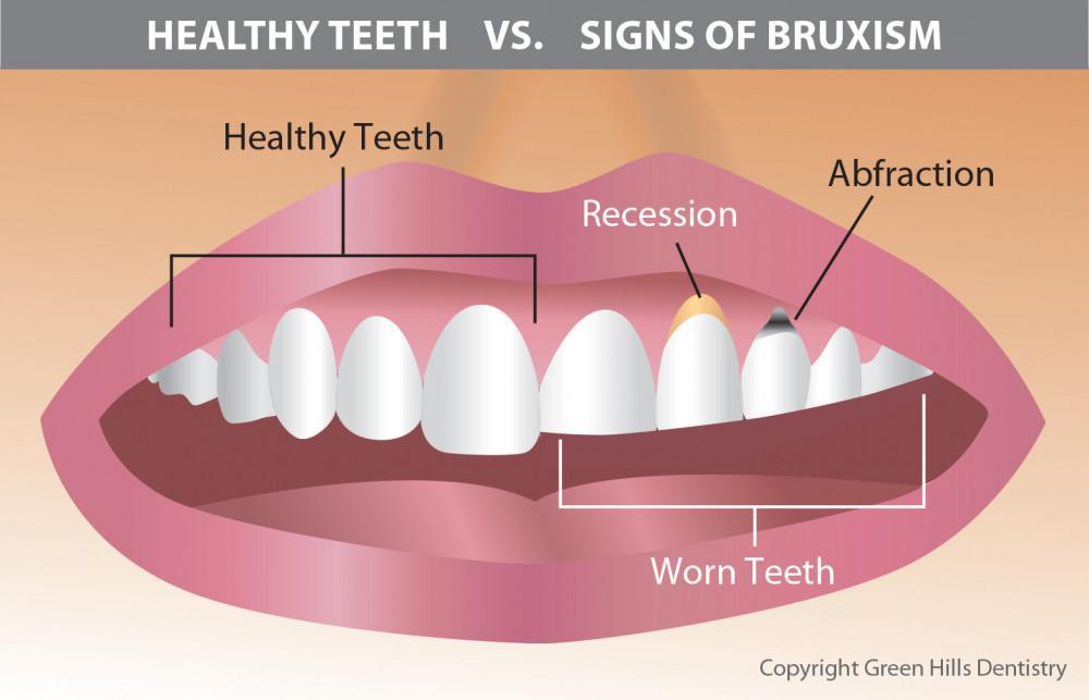 Content image for Dental Care and Grinding Teeth (Bruxism): Protecting Your Smile at Night