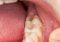 Featured image for The Anxiety of Wisdom Teeth Removal: Understanding the Procedure and Recovery