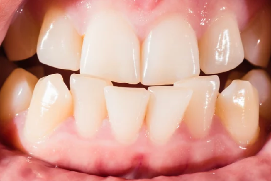 Content image for Dental Care for Badly Crooked Teeth: Exploring Orthodontic Solutions