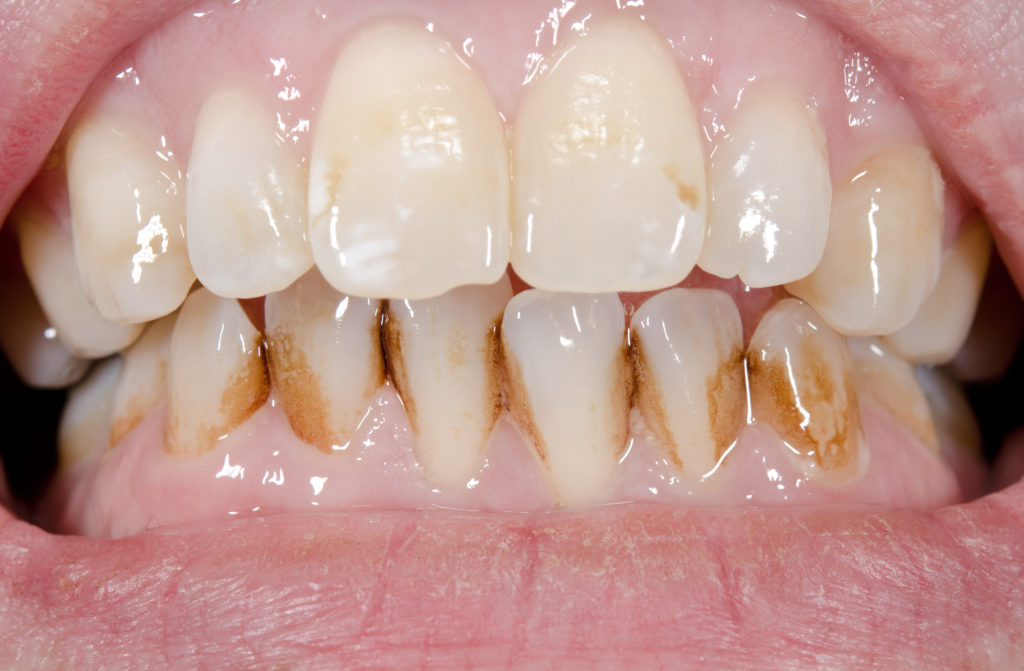 Content image for Dental Care for Smokers: Understanding the Increased Risks to Oral Health