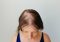 Featured image for Hair Loss Frustration: Why Am I Losing More Hair Than Ever Before?