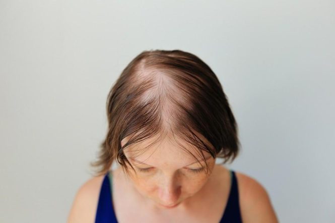 Featured image for Hair Loss Frustration: Why Am I Losing More Hair Than Ever Before?