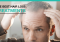 Featured image for Budgeting for Hair Loss Solutions: Affordable Treatments and Options