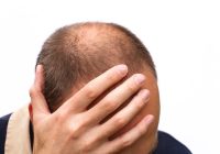 Featured image for Hair Loss Anxiety: Coping with the Emotional Impact of Thinning Hair
