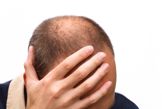 Featured image for Hair Loss Anxiety: Coping with the Emotional Impact of Thinning Hair