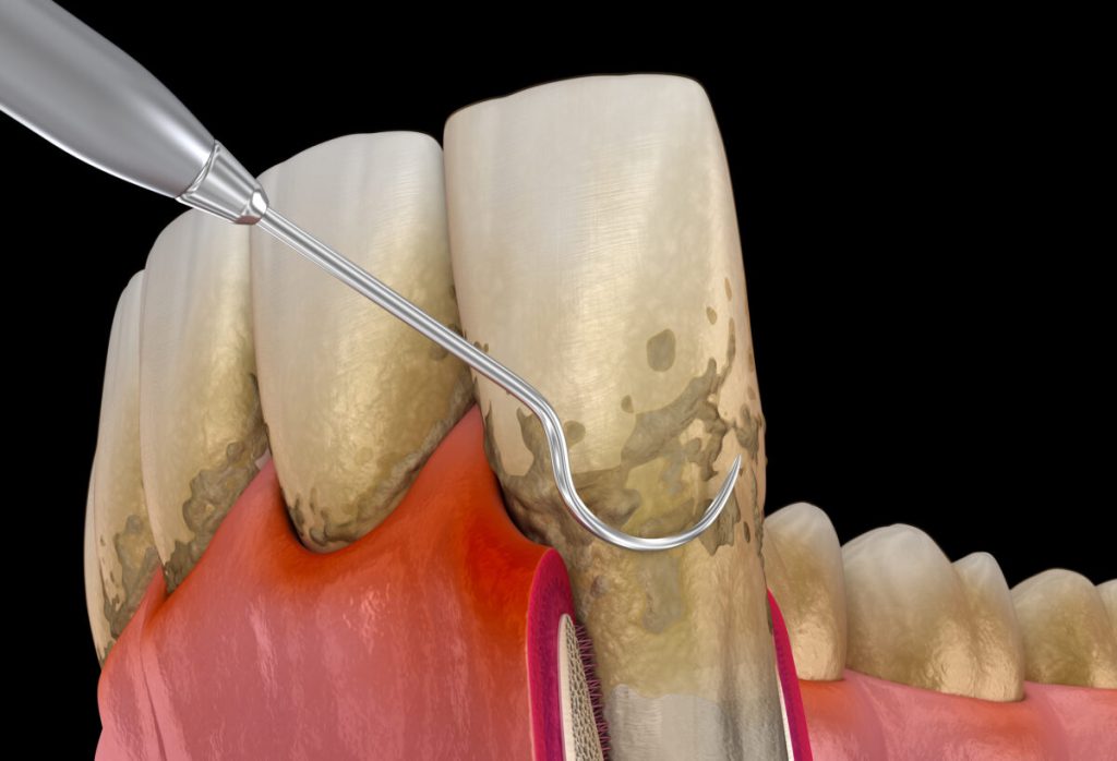 Content image for The Frustration of Plaque Buildup Even with Frequent Brushing