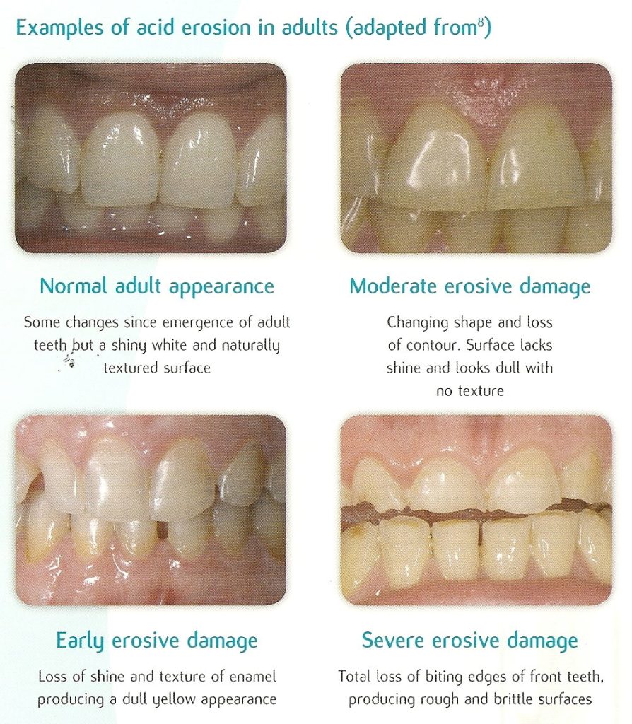 Content image for Dental Care for Tooth Erosion: Protecting Enamel from Acidic Foods and Drinks