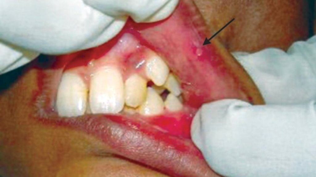 Content image for The Discomfort of Mouth Sores and Ulcers: Finding Relief and Understanding Causes