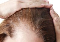 Featured image for Hair Loss in Women: Understanding the Unique Causes and Treatments
