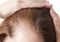 Featured image for Hair Loss in Women: Understanding the Unique Causes and Treatments