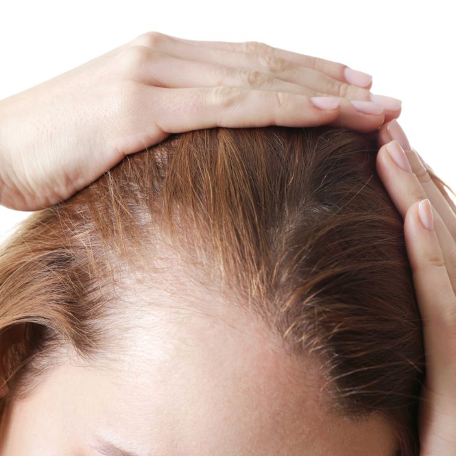 Featured image for Hair Loss in Women: Understanding the Unique Causes and Treatments