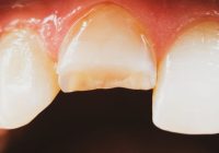 Featured image for Dental Care for Chipped or Cracked Teeth: Repairing Damage and Preventing Further Issues