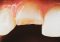 Featured image for Dental Care for Chipped or Cracked Teeth: Repairing Damage and Preventing Further Issues