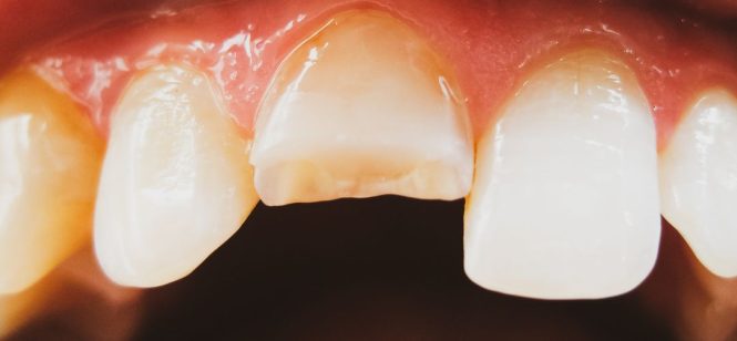 Featured image for Dental Care for Chipped or Cracked Teeth: Repairing Damage and Preventing Further Issues