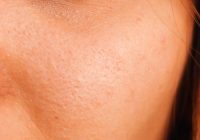 Featured image for Taming the Oil Slick: Effective Skin Care Strategies for Excess Sebum Control