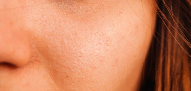 Featured image for Taming the Oil Slick: Effective Skin Care Strategies for Excess Sebum Control