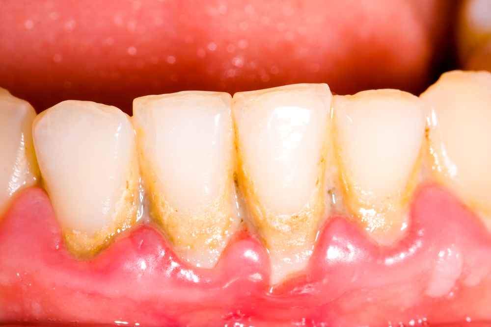 Content image for The Discomfort of Sensitive Gums and Choosing the Right Products