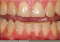 Featured image for Dental Care for Teeth Grinding in Children: Understanding Causes and Solutions