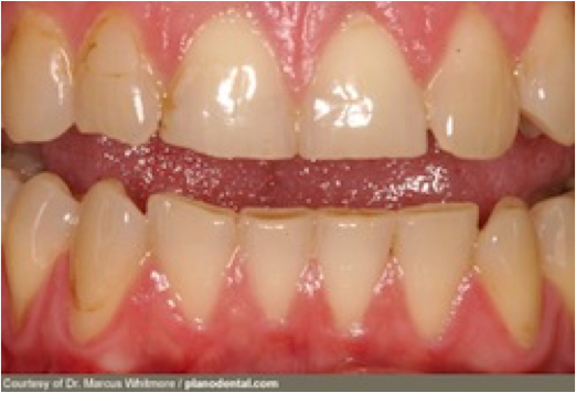 Featured image for Dental Care for Teeth Grinding in Children: Understanding Causes and Solutions