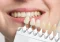 Featured image for Dental Care for Tooth Discoloration: Understanding Internal and External Stains
