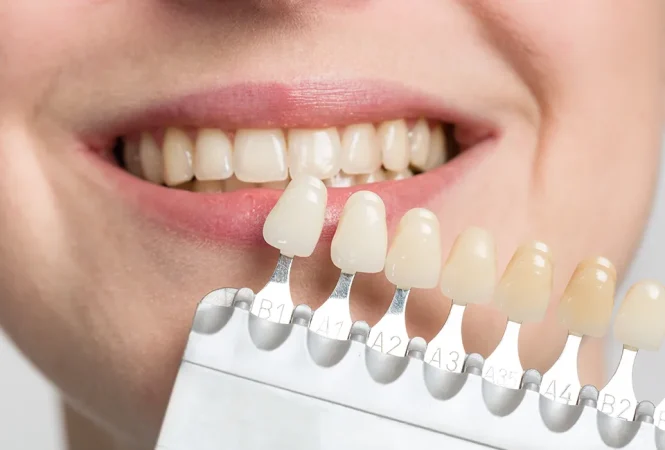 Featured image for Dental Care for Tooth Discoloration: Understanding Internal and External Stains