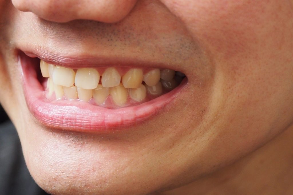 Content image for Dental Care for Tooth Discoloration: Understanding Internal and External Stains