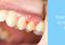 Featured image for The Discomfort of Swollen Gums and Potential Underlying Issues