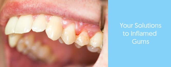 Featured image for The Discomfort of Swollen Gums and Potential Underlying Issues