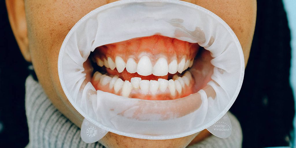 Content image for The Discomfort of Swollen Gums and Potential Underlying Issues