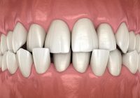 Featured image for Dental Care for Loose Teeth: Understanding the Causes and Treatment Options