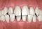 Featured image for Dental Care for Loose Teeth: Understanding the Causes and Treatment Options