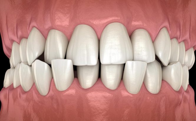 Featured image for Dental Care for Loose Teeth: Understanding the Causes and Treatment Options