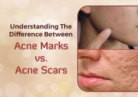 Featured image for Fading the Evidence: Effective Skin Care for Post-Acne Marks and Scars