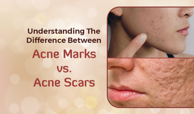 Featured image for Fading the Evidence: Effective Skin Care for Post-Acne Marks and Scars