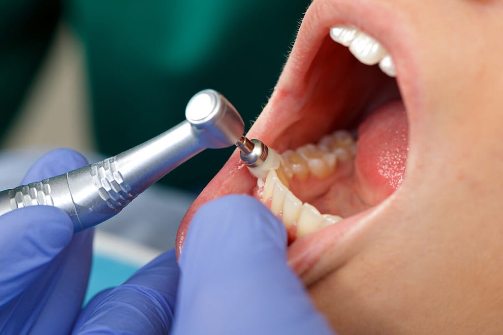 Content image for Dental Care for Loose Teeth: Understanding the Causes and Treatment Options