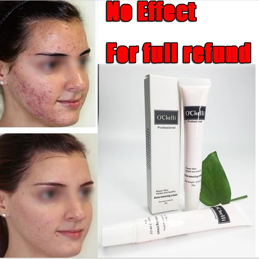 Content image for The Blackhead Battleground: Effective Strategies for Clearer Pores