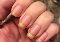 Featured image for SOS for Severely Dry Skin: Intensive Hydration Techniques That Work